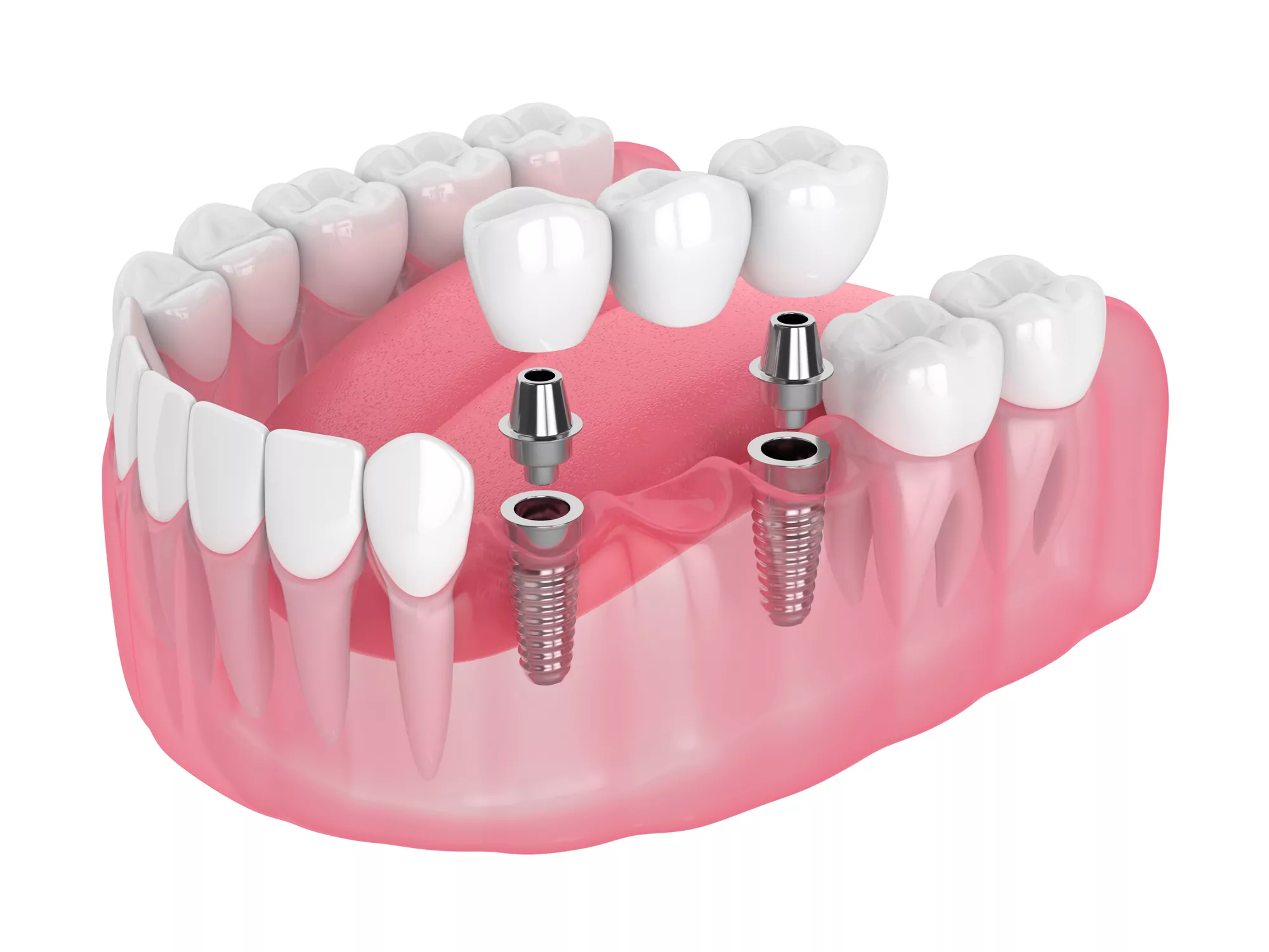 Crowns and Bridges Restoration